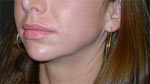mandible (jaw) implants - before