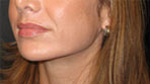 mandible (jaw) implants - after