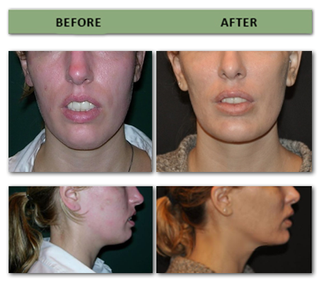 chin-augmentation-and-posterior-mandible-augmentation