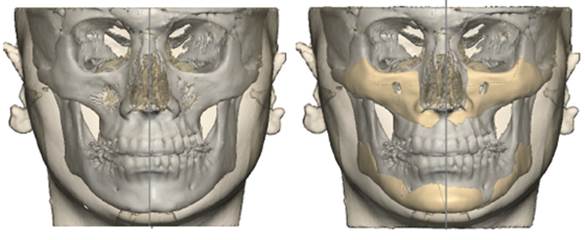 skeleton_facial_implant